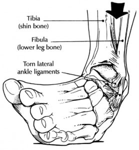 Articulo de revisión sobre el conocimiento actual en lesiones ligamentarias de tobillo